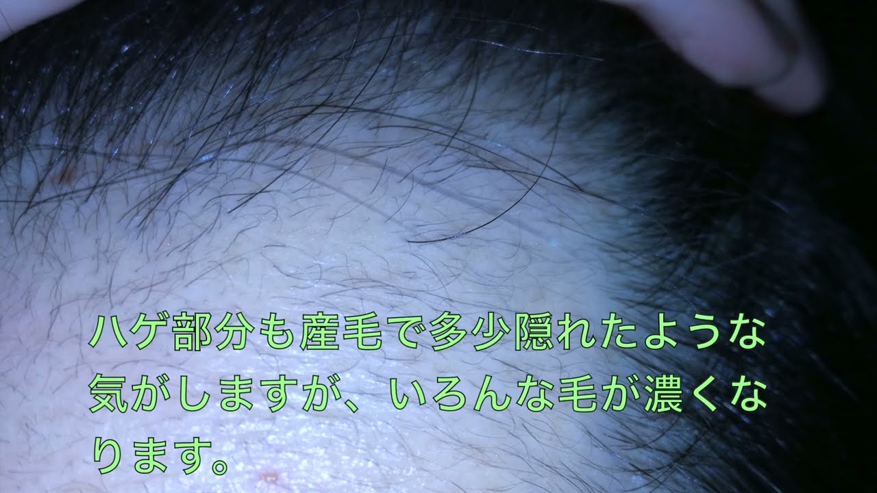 多毛症 多毛症