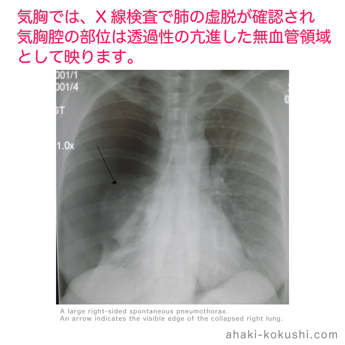 気胸 気胸