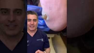 “Huge Corn” On Foot? “Huge Corn” On Foot?