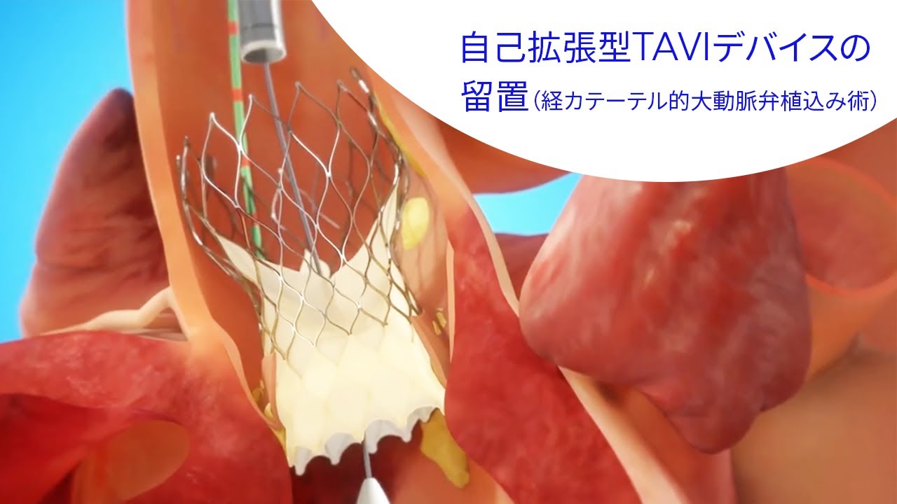 手術なしで心臓に移植? TAVI とは何かを理解する 手術なしで心臓に移植? TAVI とは何かを理解する