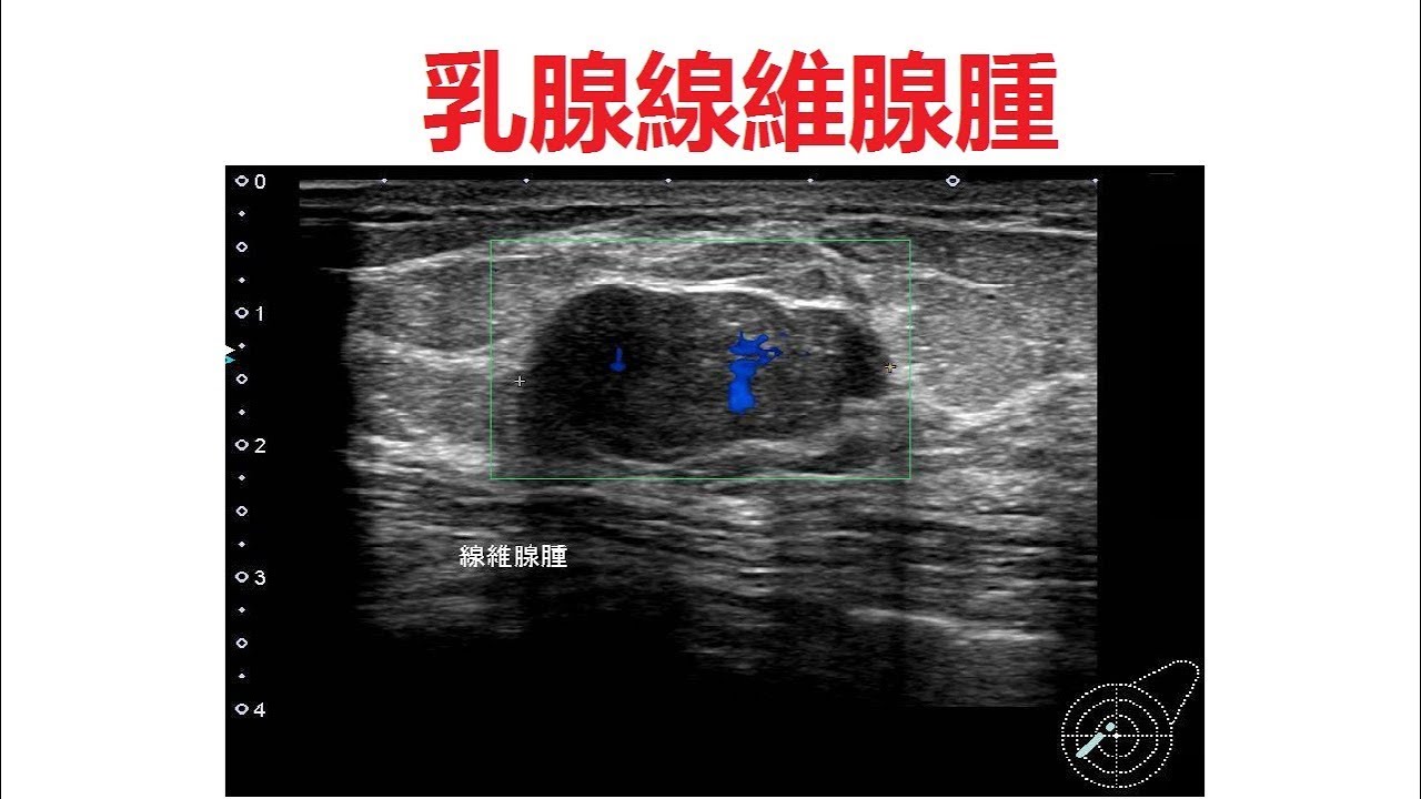 乳房線維腺腫:それは何ですか?また治療の選択肢は何ですか? 乳房線維腺腫:それは何ですか?また治療の選択肢は何ですか?