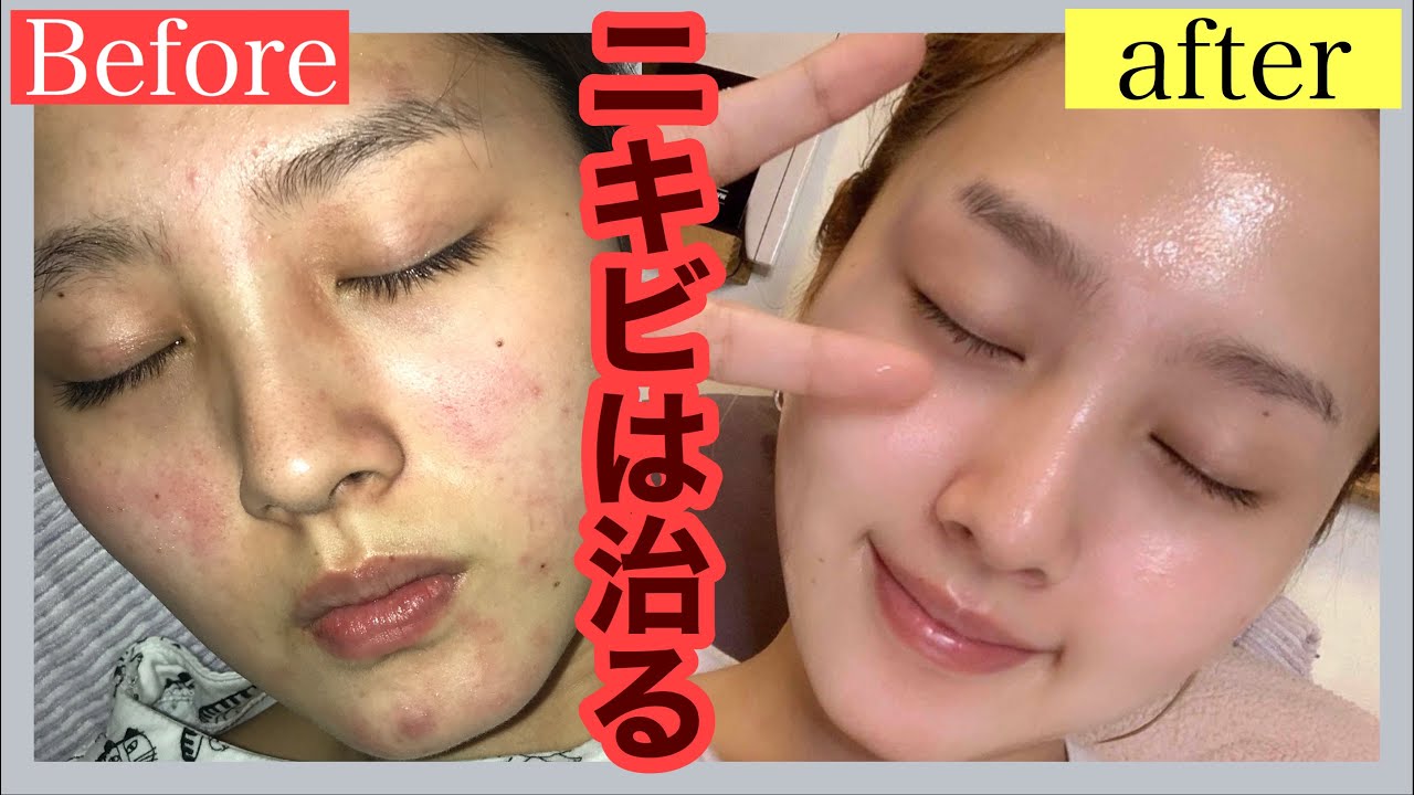ニキビ肌:ニキビの見分け方とケア方法を学ぶ ニキビ肌:ニキビの見分け方とケア方法を学ぶ