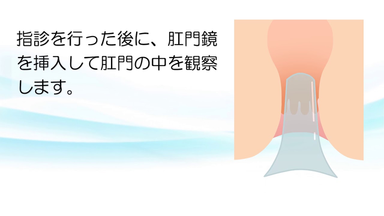 結腸肛門科医の診察を受ける時期はいつですか? 結腸肛門科医の診察を受ける時期はいつですか?