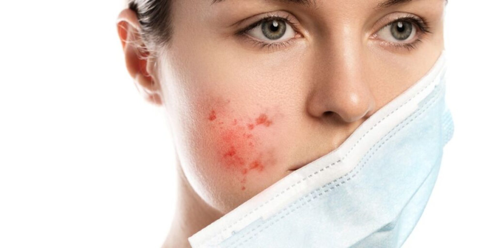 How Can You Treat Body Acne and Prevent Breakouts? How Can You Treat Body Acne and Prevent Breakouts?