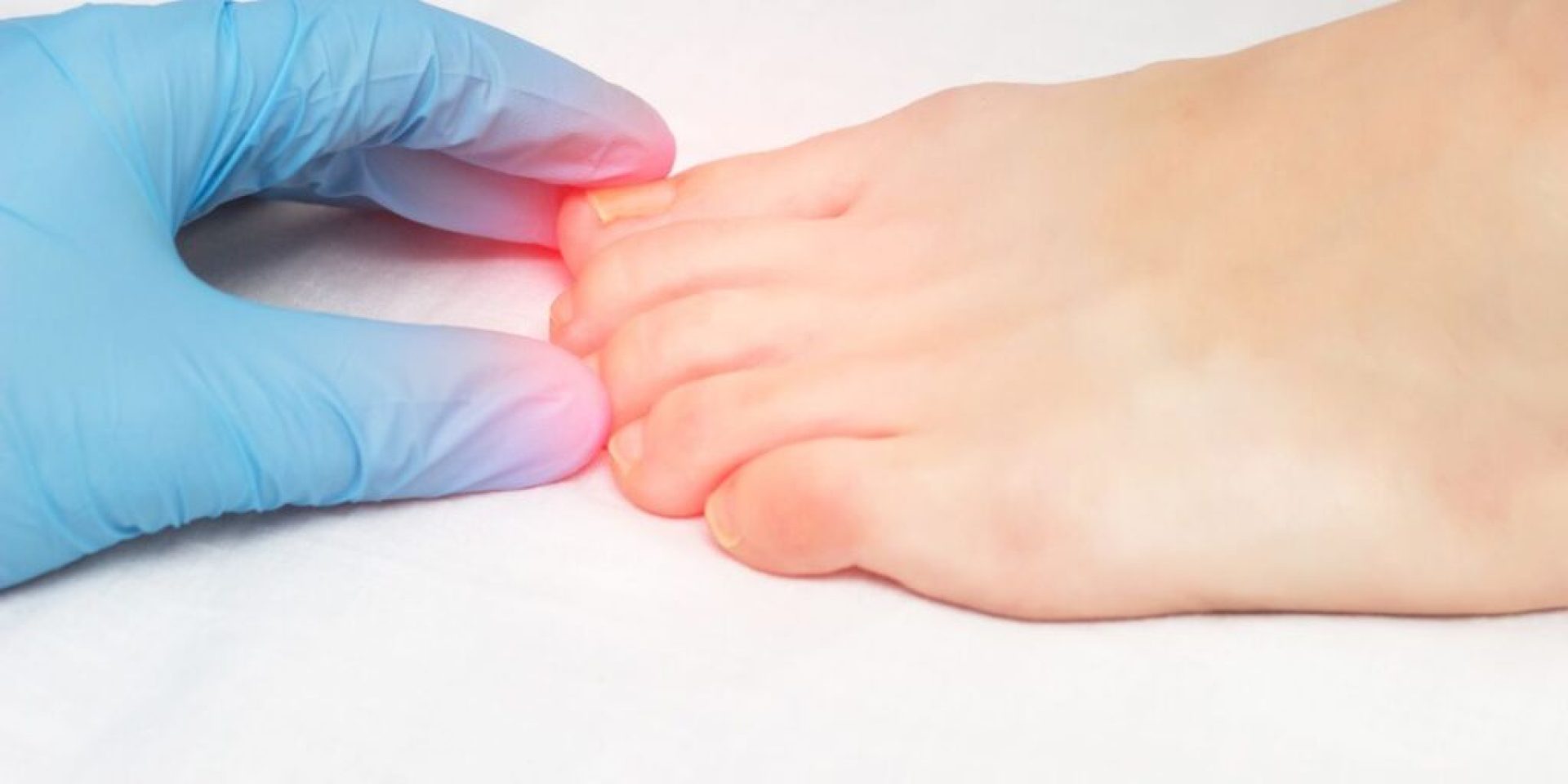How to Treat and Prevent Nail Fungus Naturally How to Treat and Prevent Nail Fungus Naturally