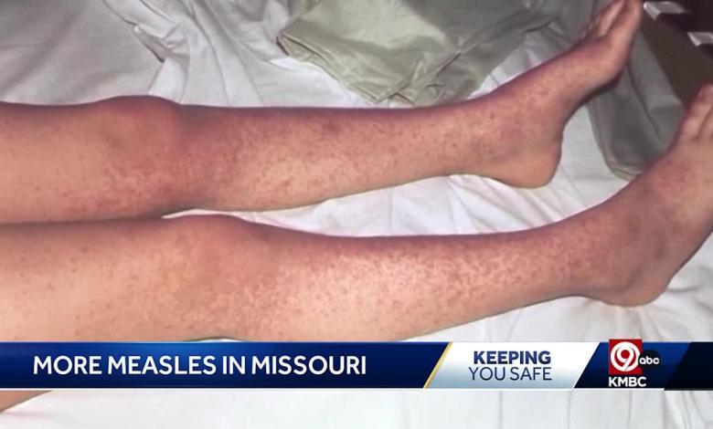 Possible measles exposure in major Missouri subways Possible measles exposure in major Missouri subways