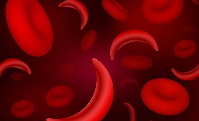Ghana: Govt Poised to Eliminate Sickle Cell Disease Threat Ghana: Govt Poised to Eliminate Sickle Cell Disease Threat