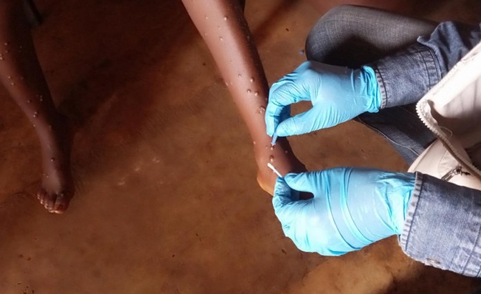 Angola With Two Positive Cases of Mpox Angola With Two Positive Cases of Mpox