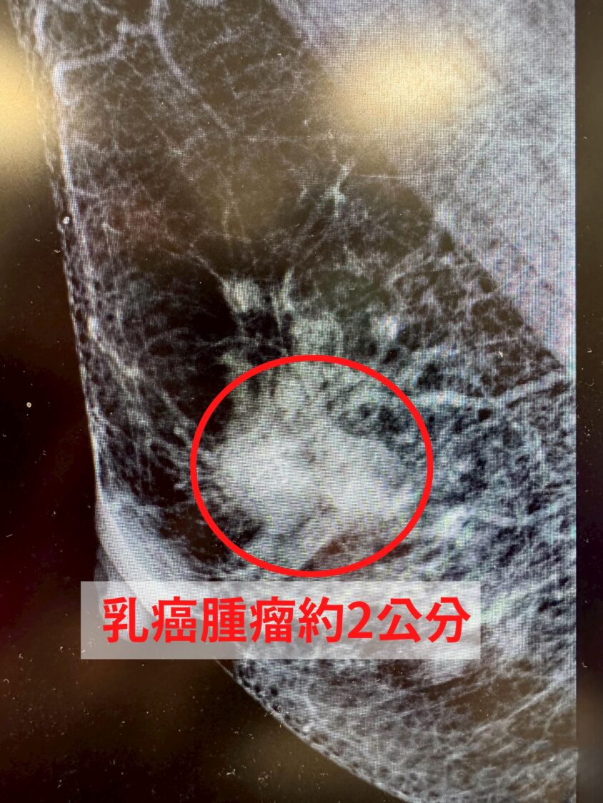 乳頭濕疹竟藏乳癌!中醫大新竹附醫揭罕見Paget氏病真相 | 索引新聞 INDEX News 乳房影像檢查顯示乳頭下方腫瘤約2公分,經穿刺切片確診為乳癌第二期,提醒女性若乳頭異常滲液、濕疹不癒應儘早就醫。(圖/記者張家燁翻攝)
