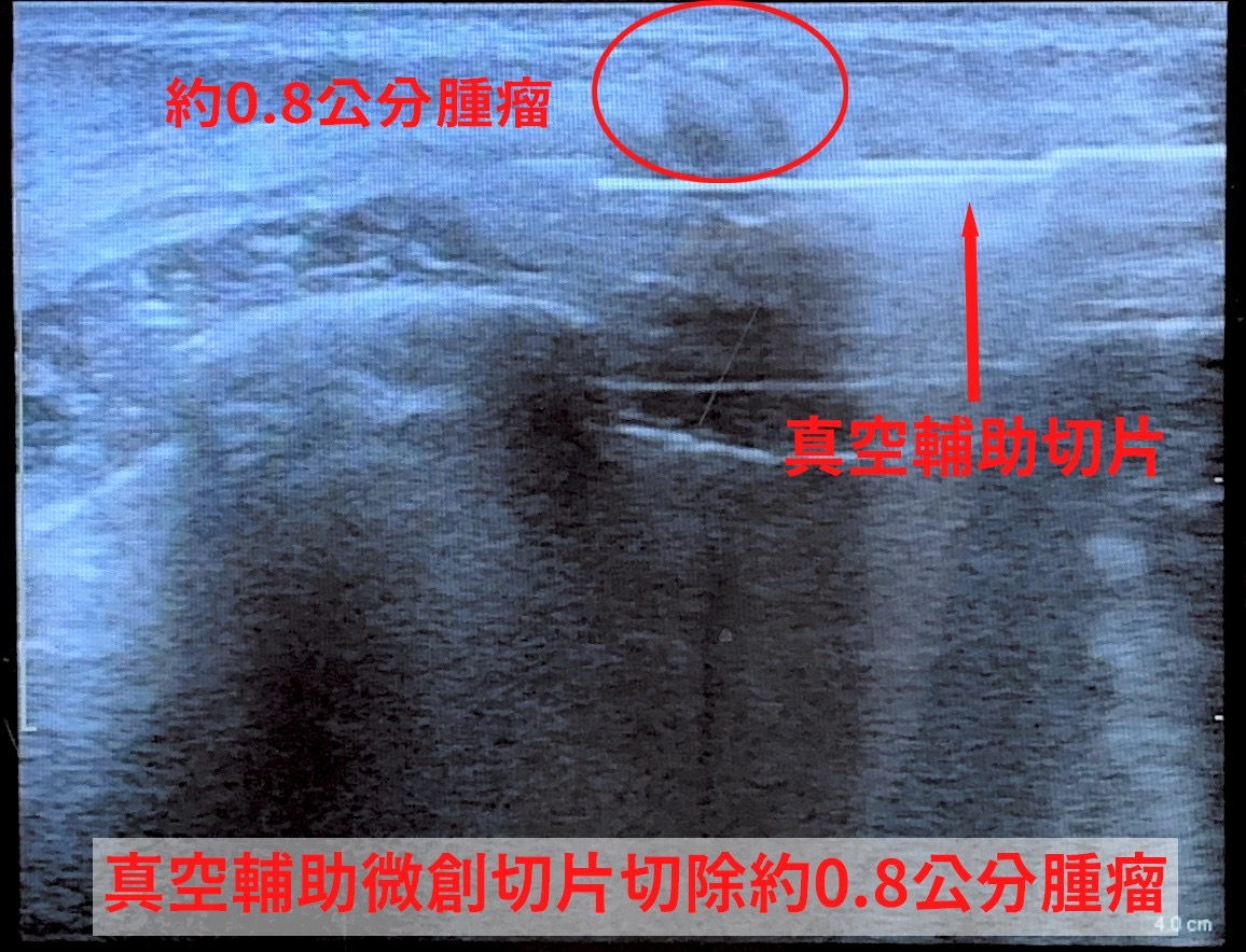 年輕乳房也會長腫瘤 真空輔助微創手術減少傷口保美觀 真空輔助微創切片影像示意圖,可見約0.8公分的乳房腫瘤,透過真空輔助微創切片完整移除病灶,達到診斷與治療雙重目的。(圖/記者張家燁翻攝)