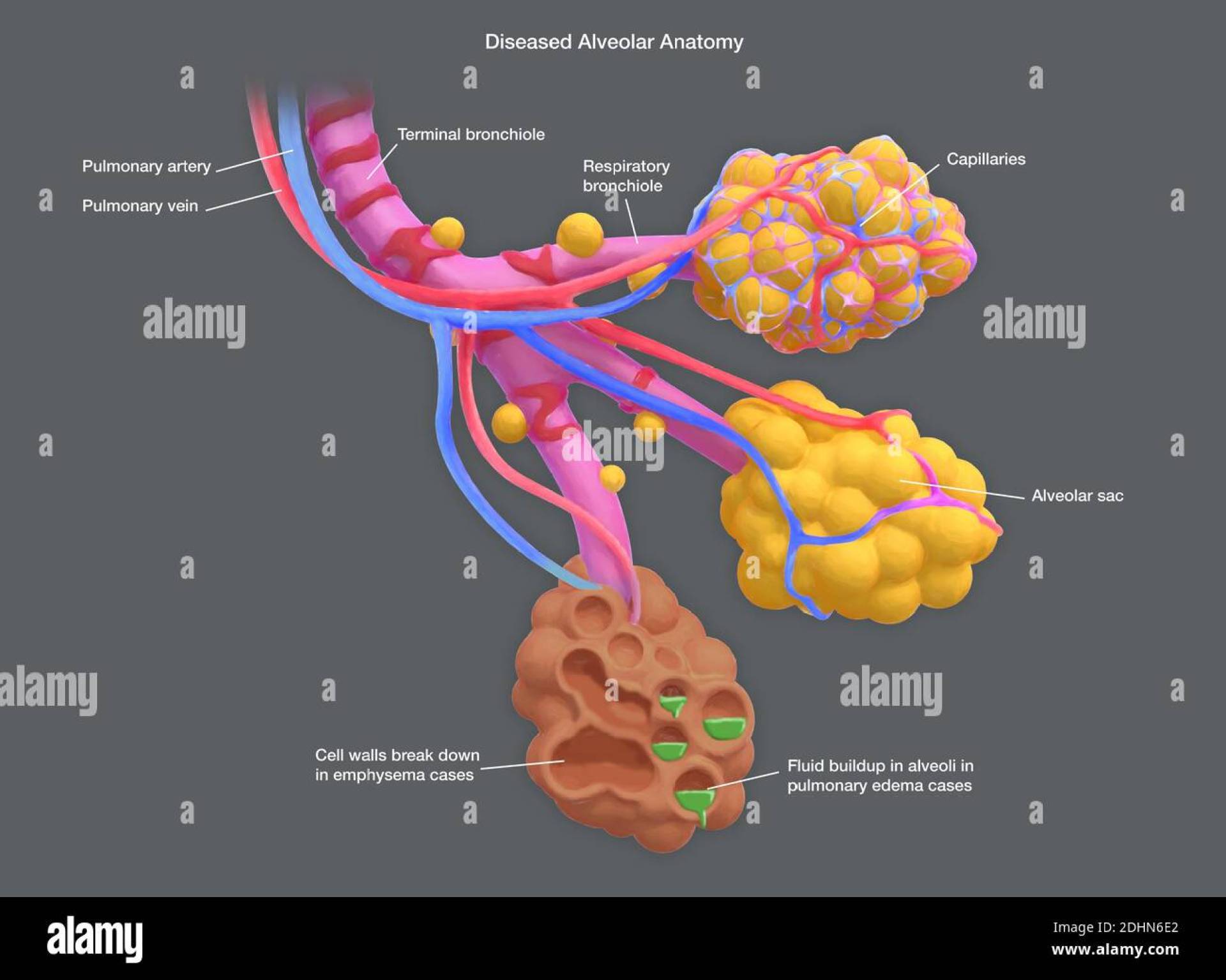 How Smoking Damages Your Lungs Stroma and Alveolar Sacs How Smoking Damages Your Lungs Stroma and Alveolar Sacs