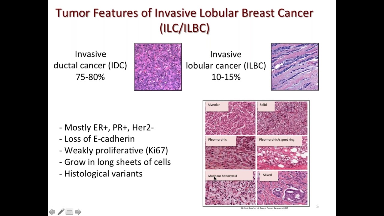 Does Lobular Carcinoma Invade Stroma? Does Lobular Carcinoma Invade Stroma?