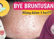 Mengatasi Bruntusan di Wajah Secara Alami: Panduan Lengkap dengan Bahan Alami Teruji Klinis Mengatasi Bruntusan di Wajah Secara Alami: Panduan Lengkap dengan Bahan Alami Teruji Klinis