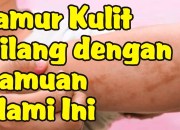 Mengatasi Jamur Kulit yang Membandel: Pendekatan Komprehensif dan Spesifik Mengatasi Jamur Kulit yang Membandel: Pendekatan Komprehensif dan Spesifik