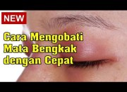 Mengatasi Kelopak Mata Bengkak: Panduan Komprehensif Berdasarkan Penyebab dan Solusi Spesifik Mengatasi Kelopak Mata Bengkak: Panduan Komprehensif Berdasarkan Penyebab dan Solusi Spesifik