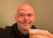 Senator John Fetterman Shares Photo After Fall, 20 Stitches and Cardiac Scare Senator John Fetterman Shares Photo After Fall, 20 Stitches and Cardiac Scare