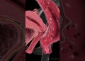 Endometriosis Beyond the Uterus | 3D Animation Endometriosis Beyond the Uterus | 3D Animation