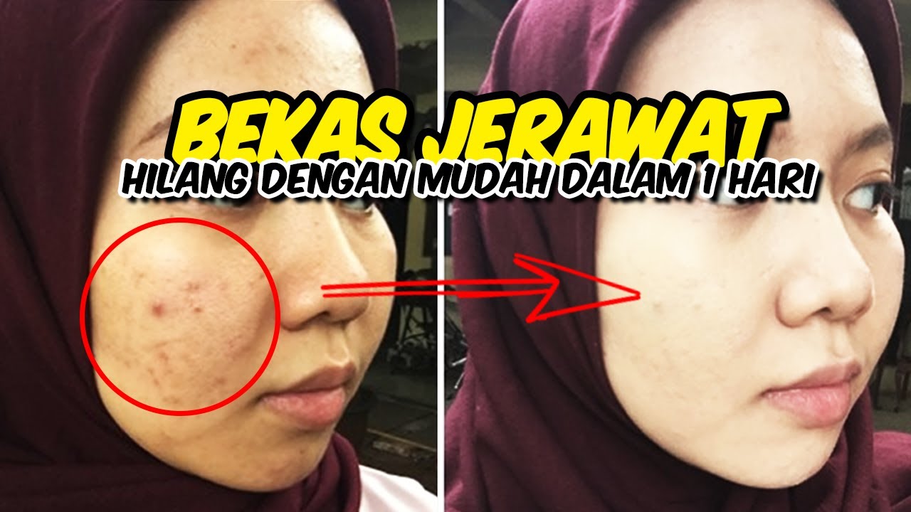 Cara Ampuh Menghilangkan Bekas Jerawat Dengan Cepat Cara Ampuh Menghilangkan Bekas Jerawat Dengan Cepat