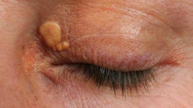 Man on carnivore diet has cholesterol of 1,000, sees shocking symptom appear on hands Man on carnivore diet has cholesterol of 1,000, sees shocking symptom appear on hands