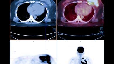 8th-grader makes concerning discovery about tumor formation during school science project — here’s why experts should be paying attention 8th-grader makes concerning discovery about tumor formation during school science project — here’s why experts should be paying attention