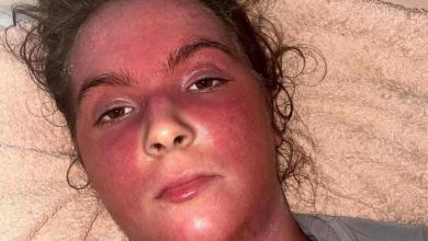 Young woman ‘would do anything to have eczema again’ after steroid withdrawal Young woman ‘would do anything to have eczema again’ after steroid withdrawal