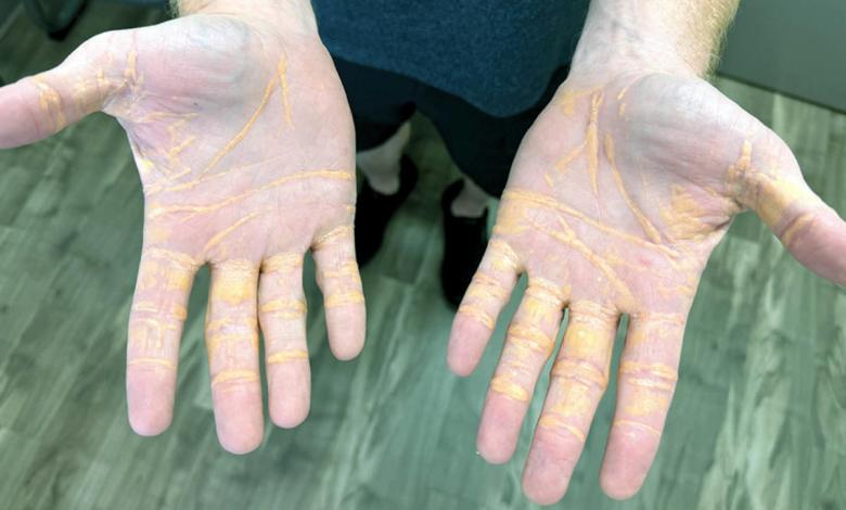 A man in the food of carnivore has cholesterol of 1 000, you see a shocking sign in the hands A man in the food of carnivore has cholesterol of 1 000, you see a shocking sign in the hands