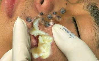 How to Clean Blackheads Safely: A Dermatologist-Informed Guide How to Clean Blackheads Safely: A Dermatologist-Informed Guide