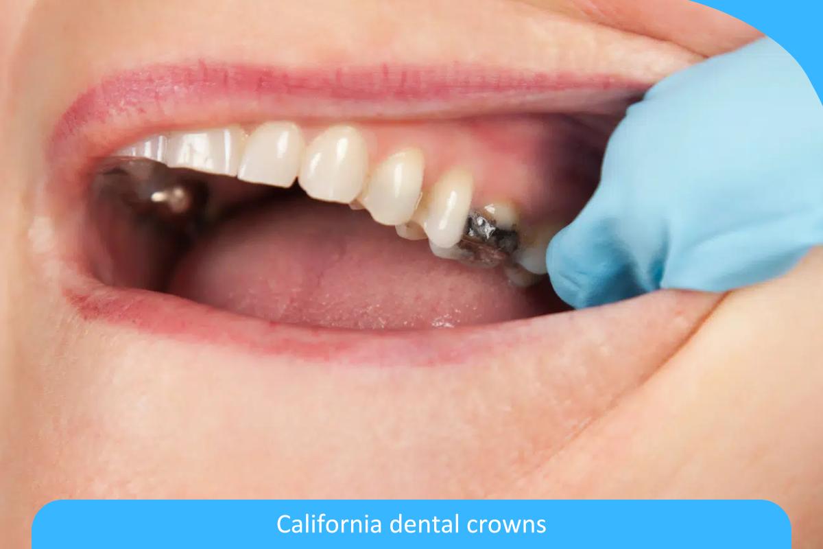 A Comprehensive Guide to California Dental Crowns: Everything You Need to Know About Materials A Comprehensive Guide to California Dental Crowns: Everything You Need to Know About Materials