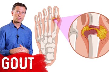 The 7 Natural Remedies for Gout The 7 Natural Remedies for Gout
