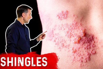 Shingles: Natural Relief Shingles: Natural Relief