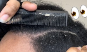 Scratching Your Head? Find The Right Dandruff Solution In South Dakota! Scratching Your Head? Find The Right Dandruff Solution In South Dakota!