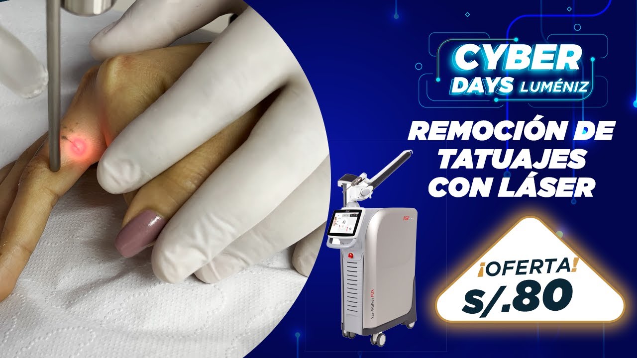 La mejor tecnologia para remover un tatuaje La mejor tecnologia para remover un tatuaje