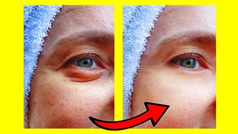 4 Remedios Caseros Para Eliminar Ojeras Y Bolsas Bajo Los Ojos 4 Remedios Caseros Para Eliminar Ojeras Y Bolsas Bajo Los Ojos