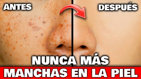 Con SOLO 1 USO ELIMINARÁS las MANCHAS de la PIEL y MARCAS del ACNÉ | Remedio Casero Manchas Oscuras Con SOLO 1 USO ELIMINARÁS las MANCHAS de la PIEL y MARCAS del ACNÉ | Remedio Casero Manchas Oscuras