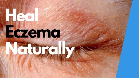 NATURAL SOLUTIONS FOR HEALING ECZEMA FAST NATURAL SOLUTIONS FOR HEALING ECZEMA FAST