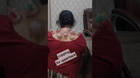 #cupping #jointpain #alternative treatment   #ayurveda #panchakarma at opd level #ytshorts #shorts #cupping #jointpain #alternative treatment   #ayurveda #panchakarma at opd level #ytshorts #shorts