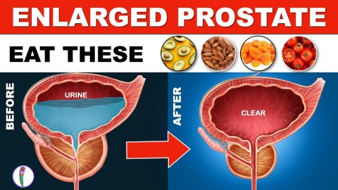 Prostate enlargement Treatment (Naturally) | Benign Prostatic Hyperplasia | Enlarged Prostate Diet Prostate enlargement Treatment (Naturally) | Benign Prostatic Hyperplasia | Enlarged Prostate Diet