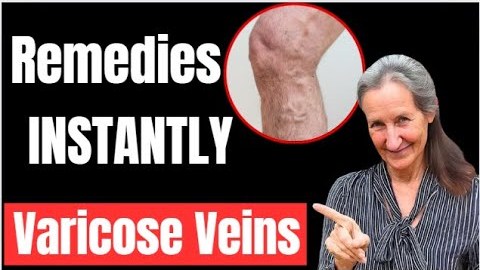 shocking Remedies For Varicose Veins and Swollen Legs  INSTANTLY | Barbara O’Neill’s shocking Remedies For Varicose Veins and Swollen Legs  INSTANTLY | Barbara O’Neill’s