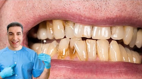 The #1 Top Remedy for Dental Plaque The #1 Top Remedy for Dental Plaque