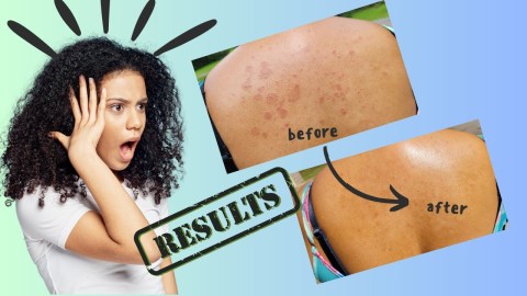 Say Goodbye to Itchy Skin: Amazing Natural Remedies for Eczema Relief! Say Goodbye to Itchy Skin: Amazing Natural Remedies for Eczema Relief!