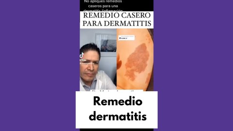 ¿Remedio casero para la dermatitis? ¿Remedio casero para la dermatitis?