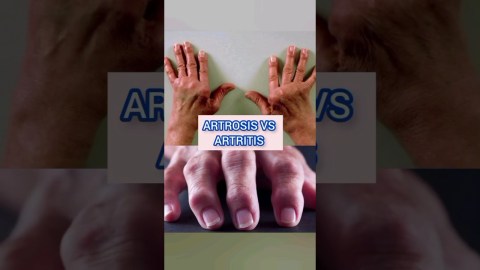 ARTROSIS  VS ARTRITIS ARTROSIS  VS ARTRITIS