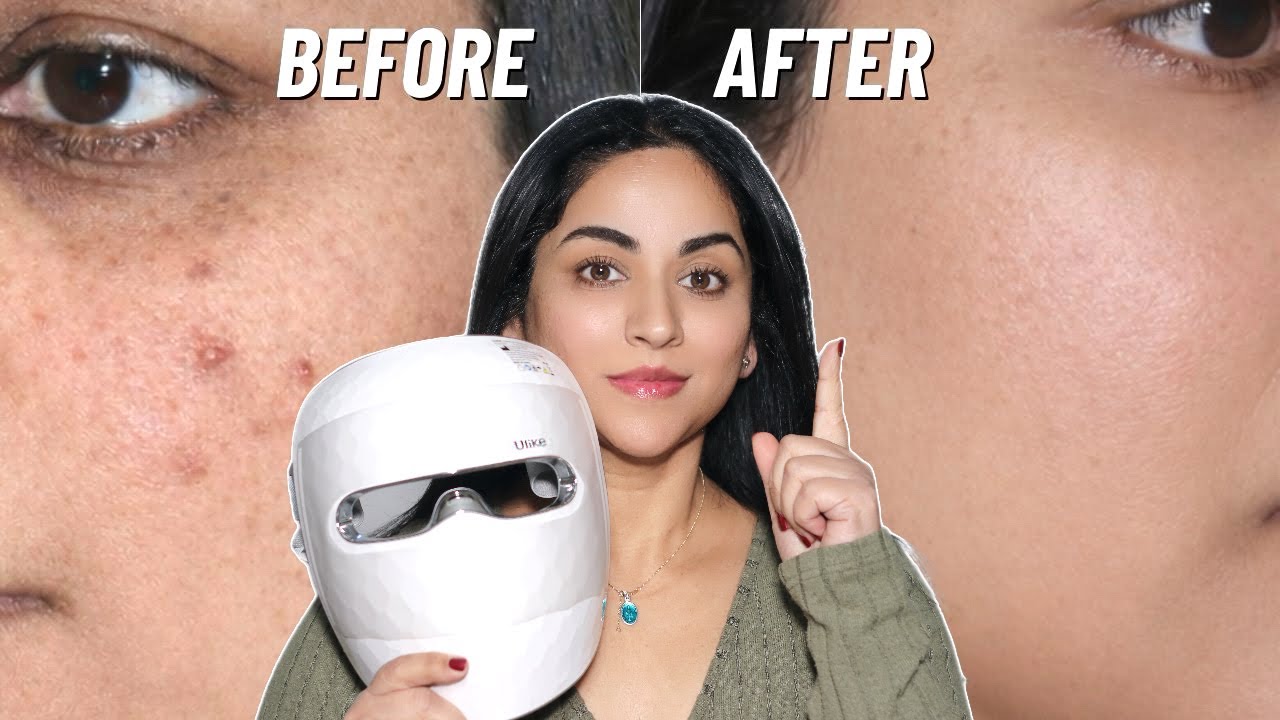 Smitha Deepak – My 1-Year Update using Ulike LED Mask (Did it Really Work?) Smitha Deepak – My 1-Year Update using Ulike LED Mask (Did it Really Work?)