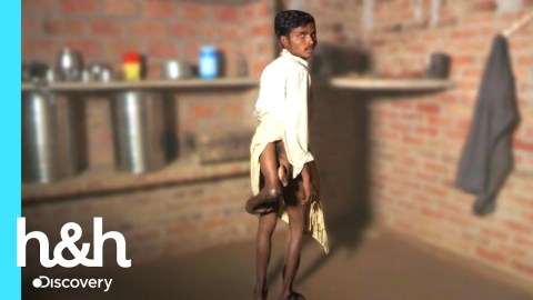 Joven nació con cuatro piernas y una pelvis extra | Mi cuerpo, mi desafío | Discovery H&H Joven nació con cuatro piernas y una pelvis extra | Mi cuerpo, mi desafío | Discovery H&H