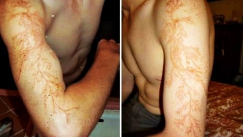 10 Personas que fueron alcanzadas por un rayo y sobrevivieron 10 Personas que fueron alcanzadas por un rayo y sobrevivieron