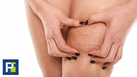 ¿La cura contra la celulitis? Una mujer en Texas asegura tener la solución para este problema ¿La cura contra la celulitis? Una mujer en Texas asegura tener la solución para este problema