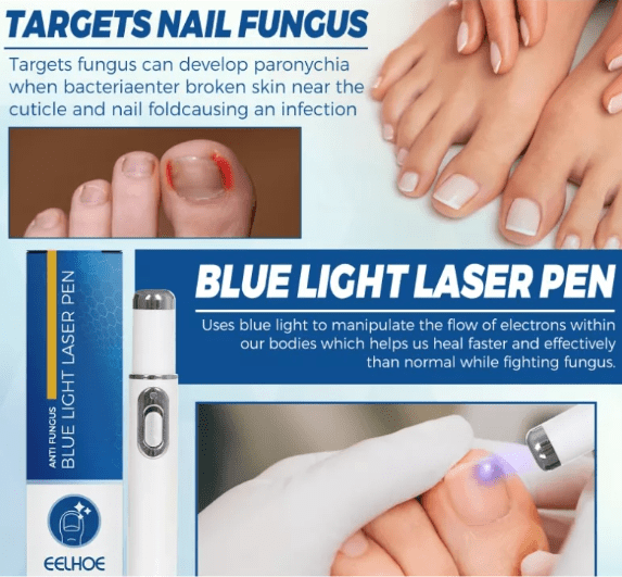 Lápiz Láser Azul Para Hongos En Las Uñas