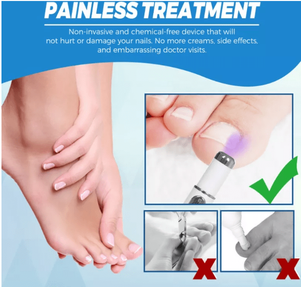 Lápiz Láser Azul Para Hongos En Las Uñas