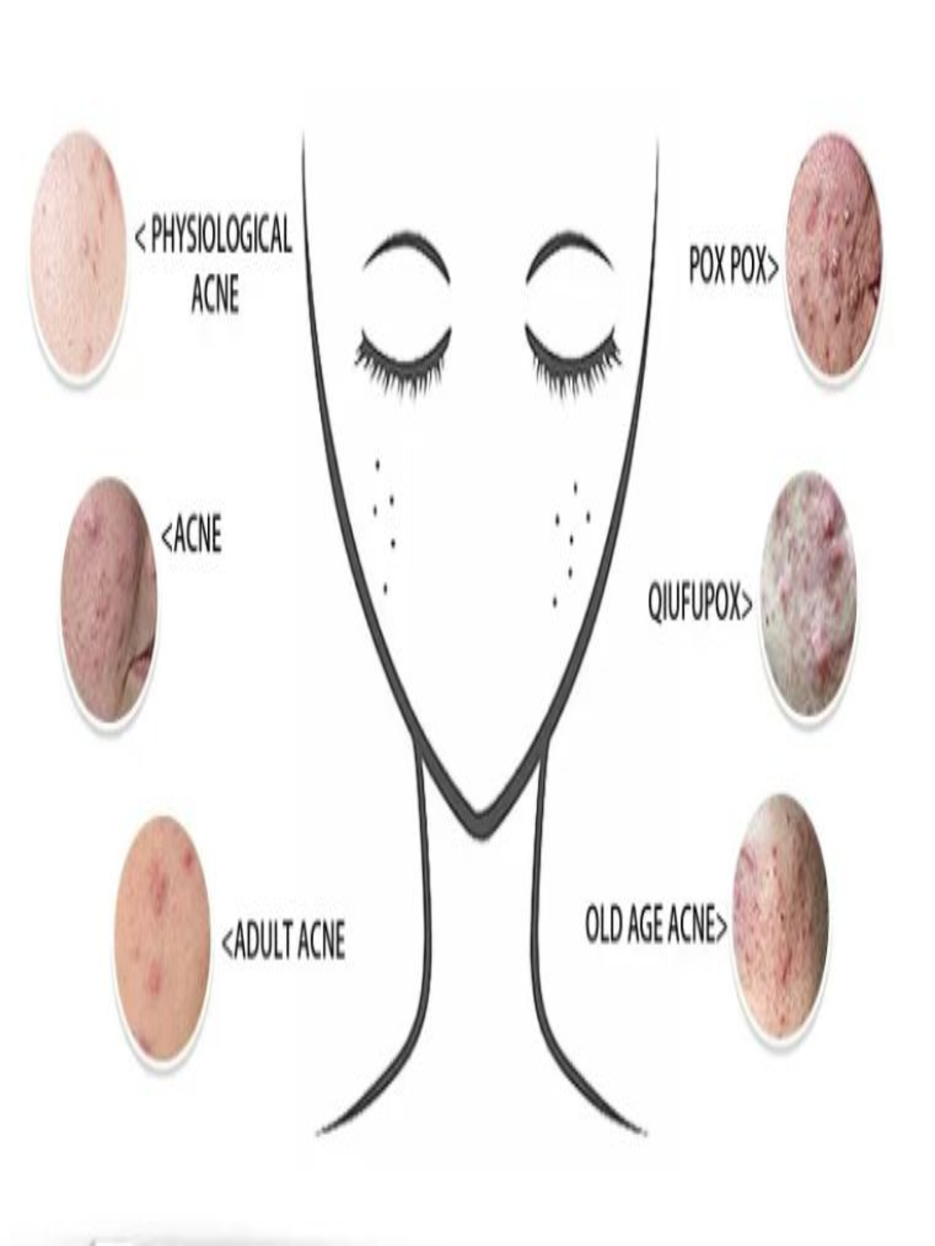Crema Anti Acne Granos Espinillas Puntos