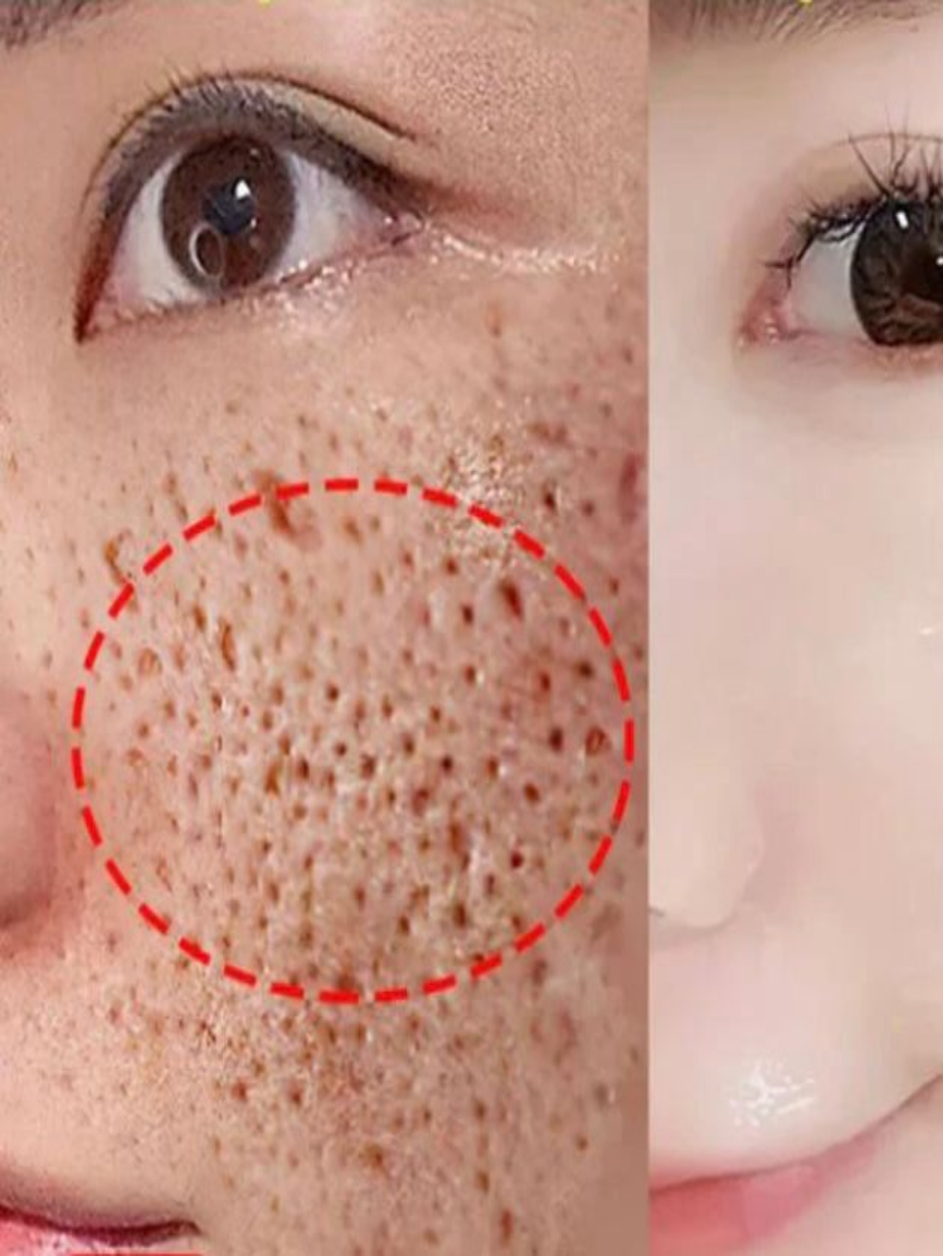 Crema Anti Acne Granos Espinillas Puntos